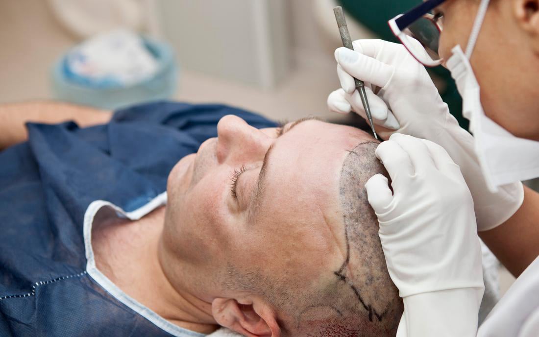 Hair Transplant treatment #Hair Loss Studio Derby