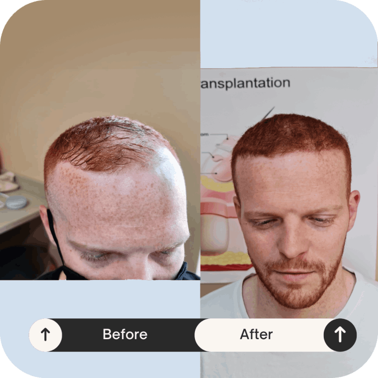 showing results for Hair Transplant in Derby