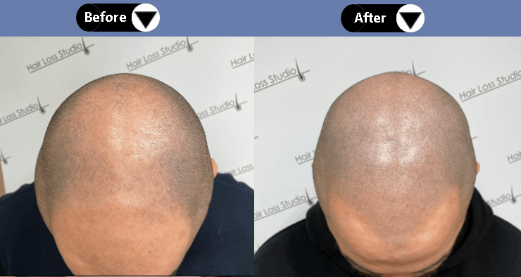 Scalp Micropigmentation (SMP) in Derby