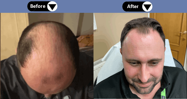 Hair Transplant in Derby at Hair Loss Study results