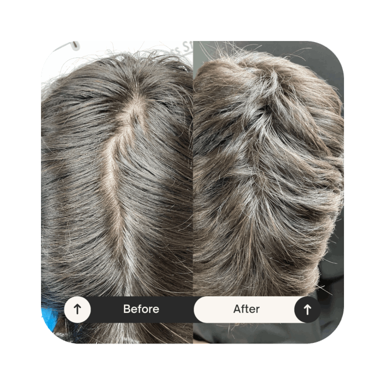 Showing result of PRP Hair Treatment in Derby