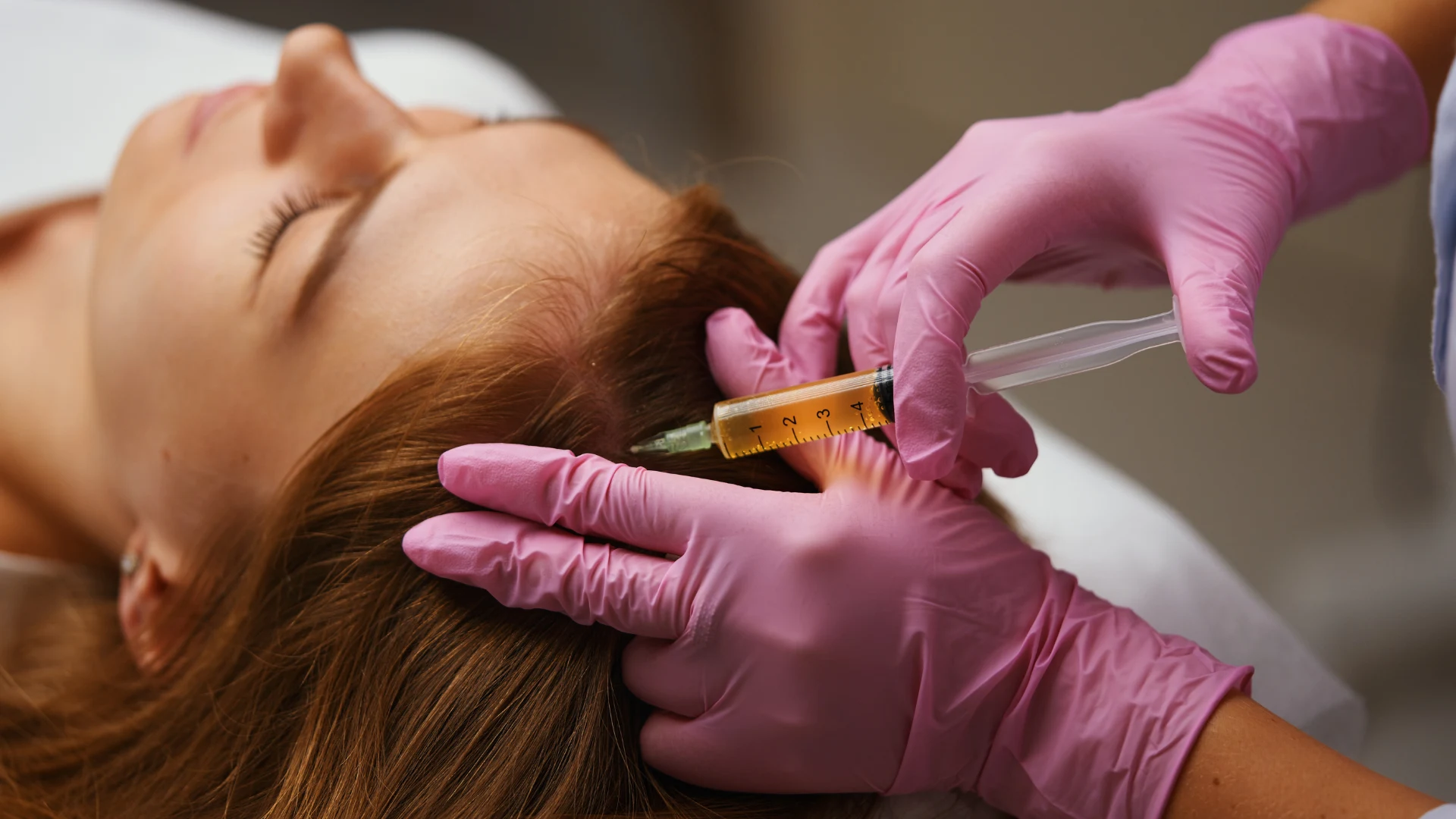 PRP Hair Treatment in Derby