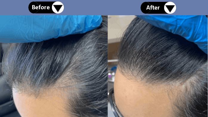 PRP Hair Treatment in Derby