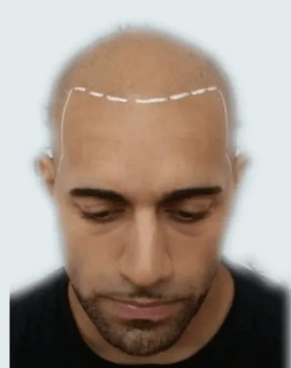 Male ready for Scalp Midro Pigmentation at Hair LOss Study Derby - Leicester - Nottingham