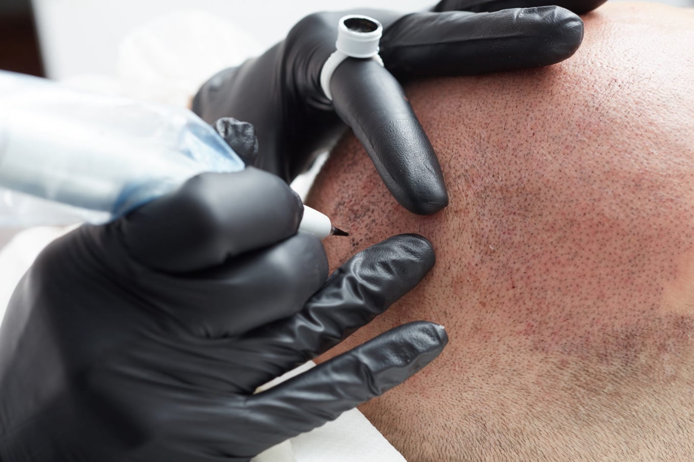 Scalp Micropigmentation (SMP) in Derby