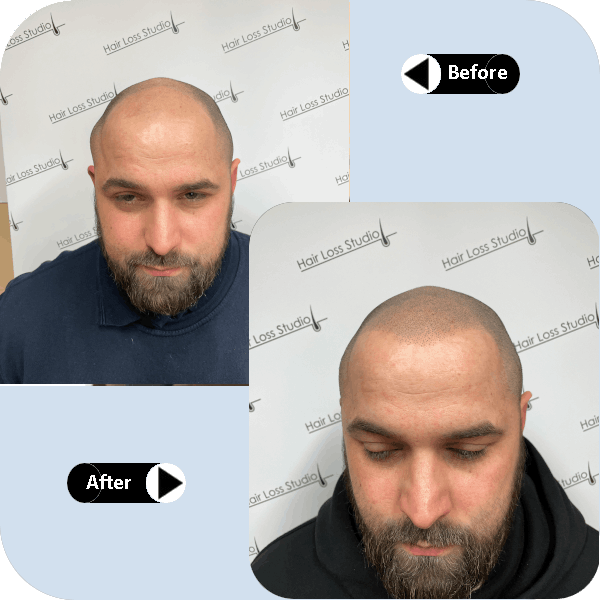 Hair Loss Stiod showing Scalp Micropigmentation (SMP) in Derby