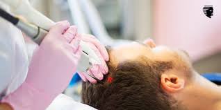 Low-Level Laser Therapy (LLLT) in Derby