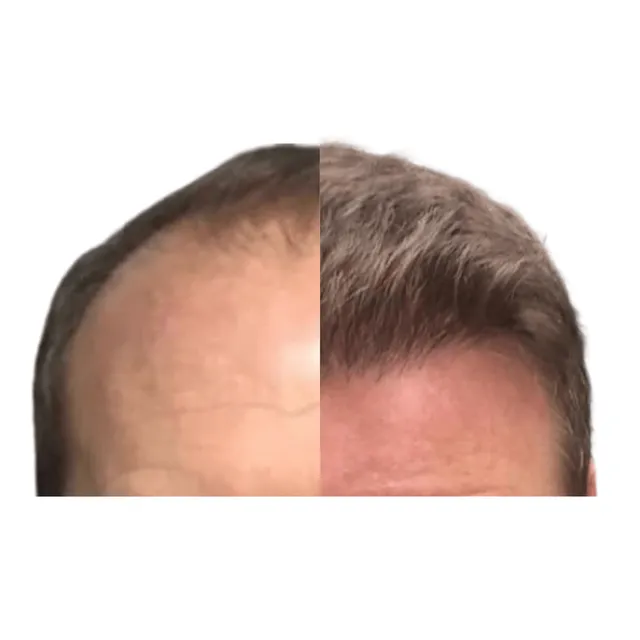 Hair Loss Studio Derby Consultation